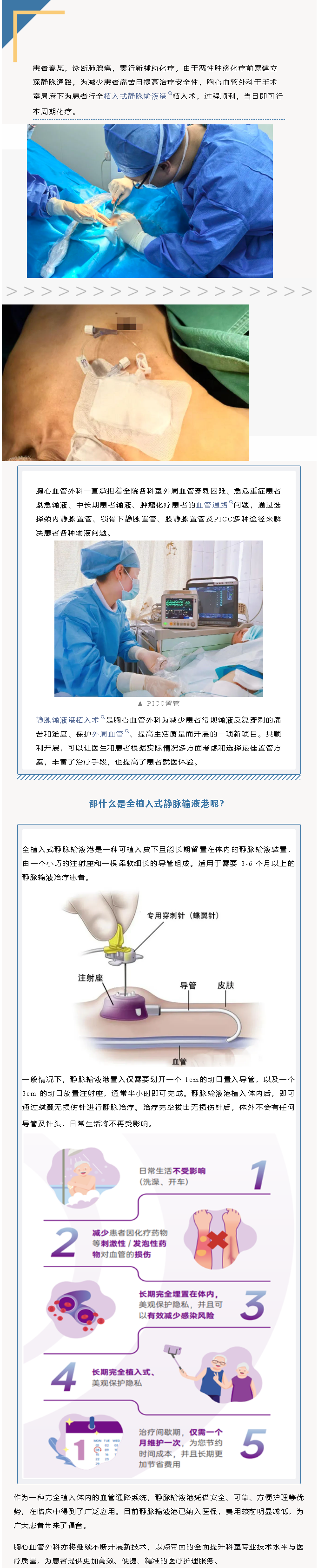 房医人文｜胸心血管外科新技术提升患者就医体验(图1)